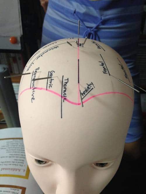 Acupuncture cranienne sur modèle